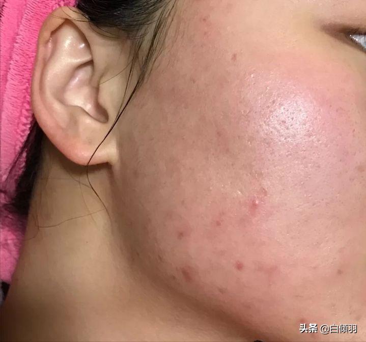 红肿痘痘不疼了但是还是有包,红肿痘痘摸着软软的一直不冒白头