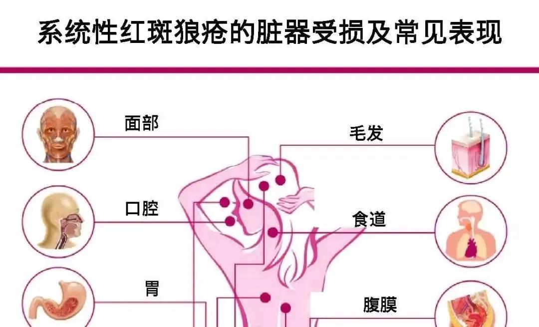 系统性红斑狼疮新药研发首批上市,系统性红斑狼疮治疗新药新进展