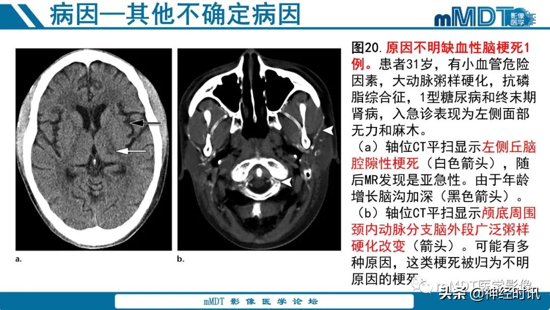 急性缺血性脑卒中ppt素材图片,青年缺血性脑卒中ppt