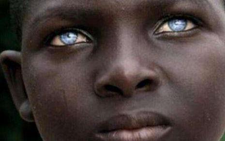 蓝色眼睛宝宝是什么病,小孩蓝色眼睛是什么病