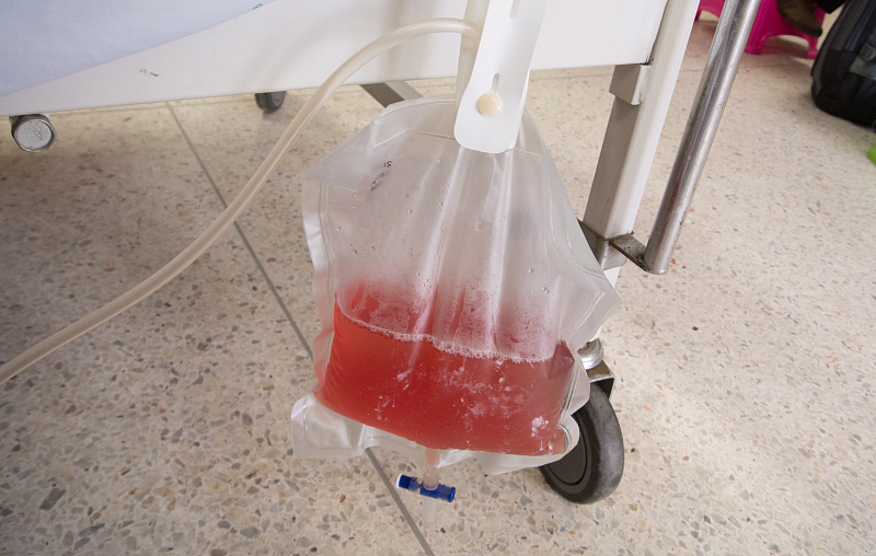 为什么要导尿插管,导尿时可自己拔管吗