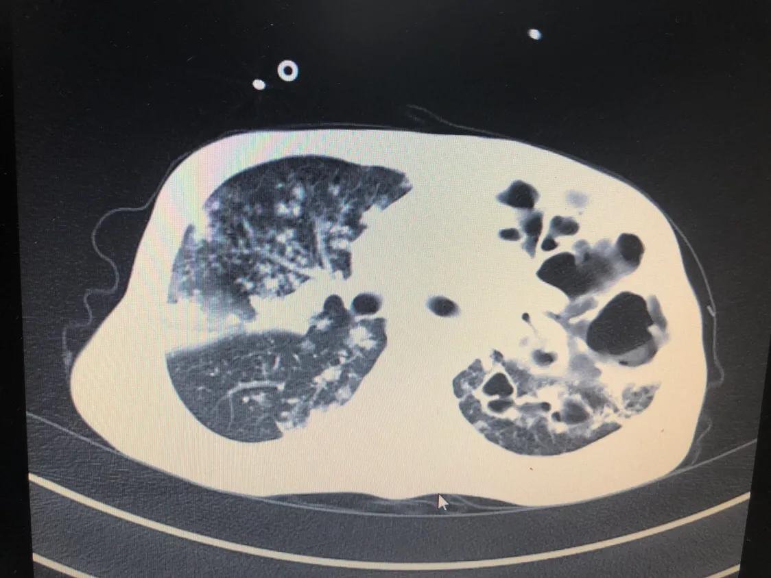 怀疑肺结核必须要做气管镜检查吗,痰里找到结核杆菌就说明肺结核吗