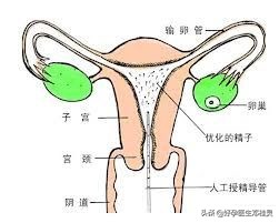 为什么输卵管粘连不孕,多年不孕宫腔粘连需要做什么手术