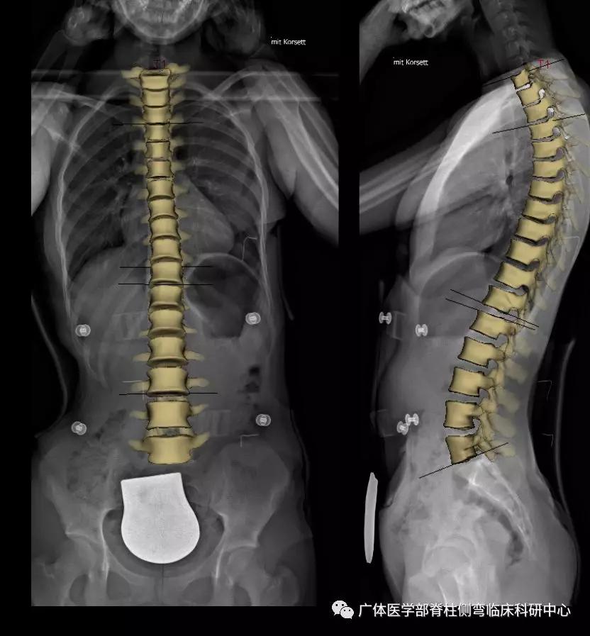 脊柱侧弯3d演示推拿,脊柱侧弯3度图片