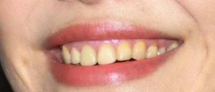 牙齿美白对牙齿有没有什么危害,牙齿美白脱色剂对牙齿有危害吗