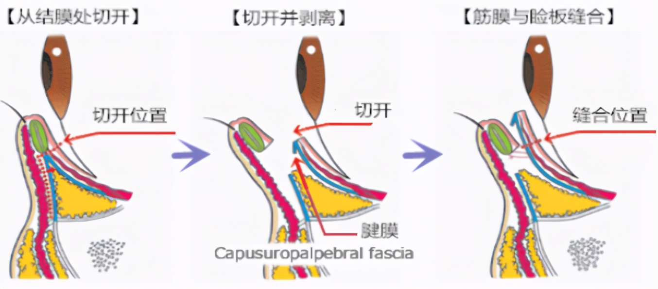 关于下睑下至，到底做还是不做？美之峰解灿告诉你