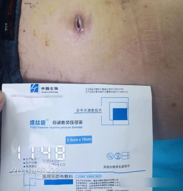 阑尾炎形成窦道的原因,阑尾炎一孔微创手术全过程