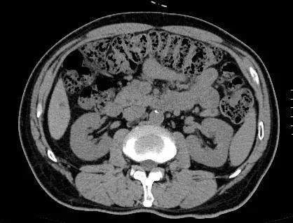 3d腹腔镜结肠手术,顽固性便秘的腹腔镜微创手术