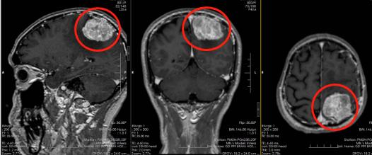 七十岁老人头长肿瘤怎么治,86岁脑袋长了鸡蛋大的肿瘤