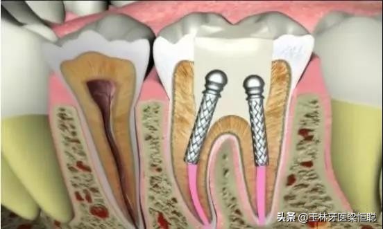 牙坏了医生说保不住为什么不给拔,牙崩了一半怎么补牙