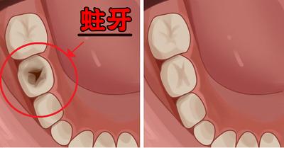 蛀牙了怎么办儿童,蛀牙了怎么办