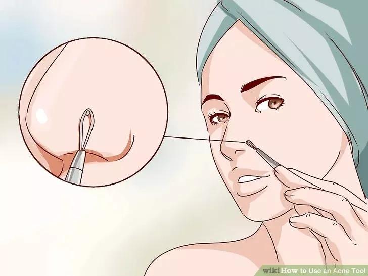 针清祛痘一般多少钱一次,针清祛痘后可以涂甲硝唑吗