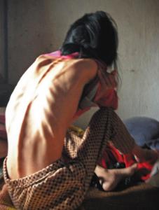 不吃饭能饿死肿瘤细胞吗,饿死的肿瘤怎么处理