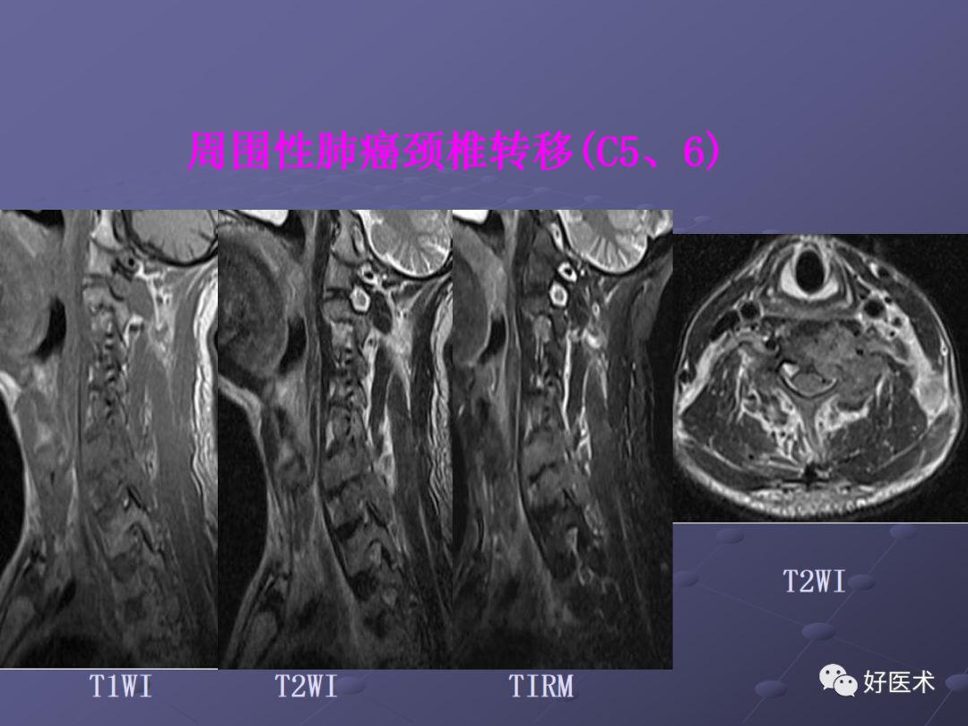 脊柱mri有哪些特点,乳腺疾病的mri诊断及鉴别