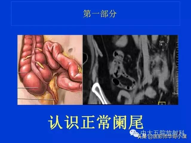 阑尾炎课件,阑尾炎的超声课件