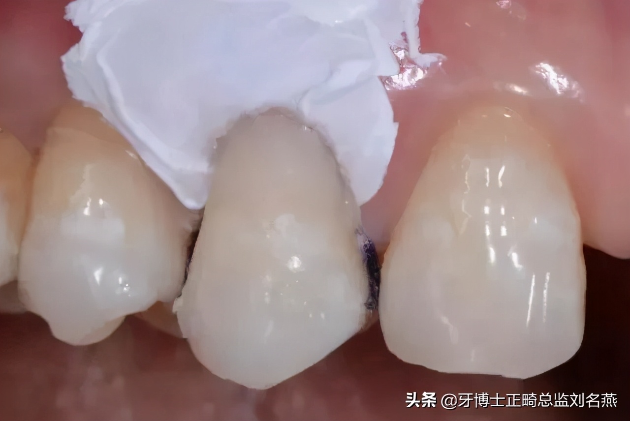 楔状缺损怎么修补,楔状缺损充填视频