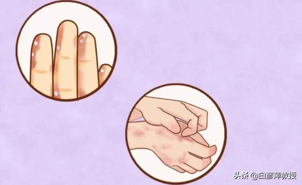 手上起红疹子是湿疹还是痱子,手上起癣湿疹是怎么治