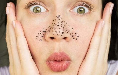 黑头拯救方法无成本,有黑头了该怎么有效去黑头