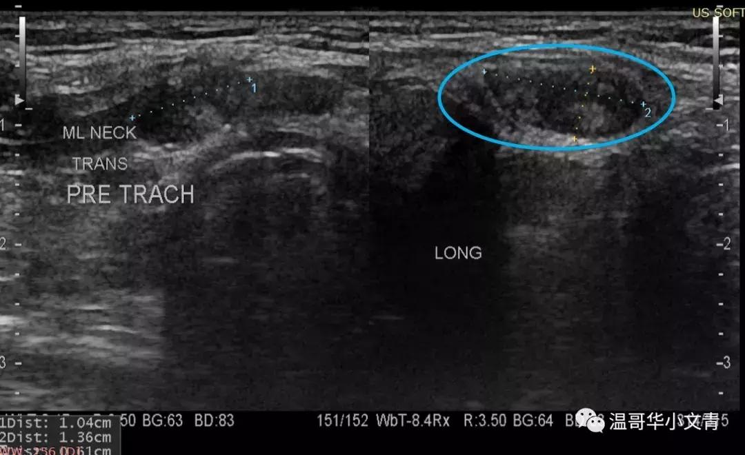 甲状腺癌治疗最好的医院,甲状腺癌的中医治疗方法