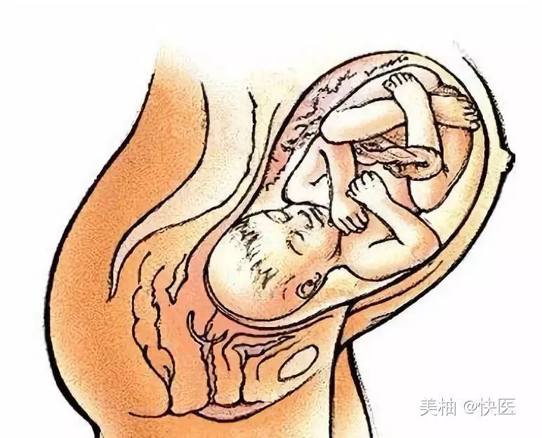 胎儿浅入盆5天会生吗,胎儿入盆的4个预兆