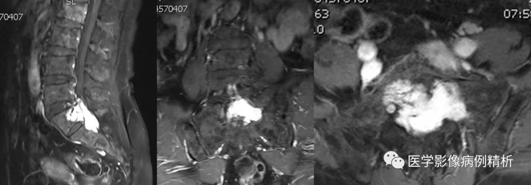 海绵状血管瘤在mri中的影像表现,骶骨处影像显示有血管瘤