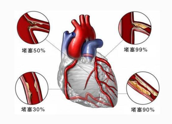 后背疼小心心梗,后背痛一定要重视