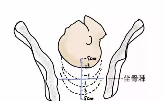 顺产宫口开几指才可以生,宫口开了2指肚子不痛多久生