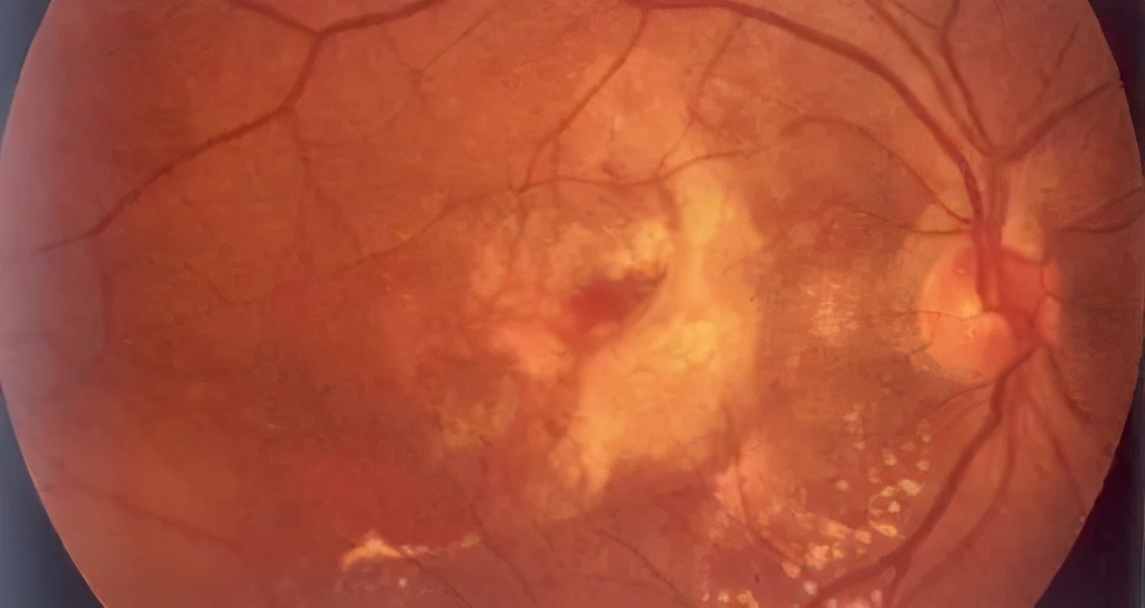 糖尿病眼底黄斑水肿打什么针好,糖尿病视网膜病变引起的黄斑水肿