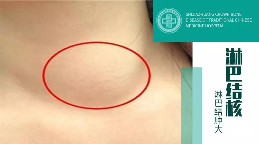 脖子上有个小肿块怎么回事,脖子上出现肿块是肿瘤吗