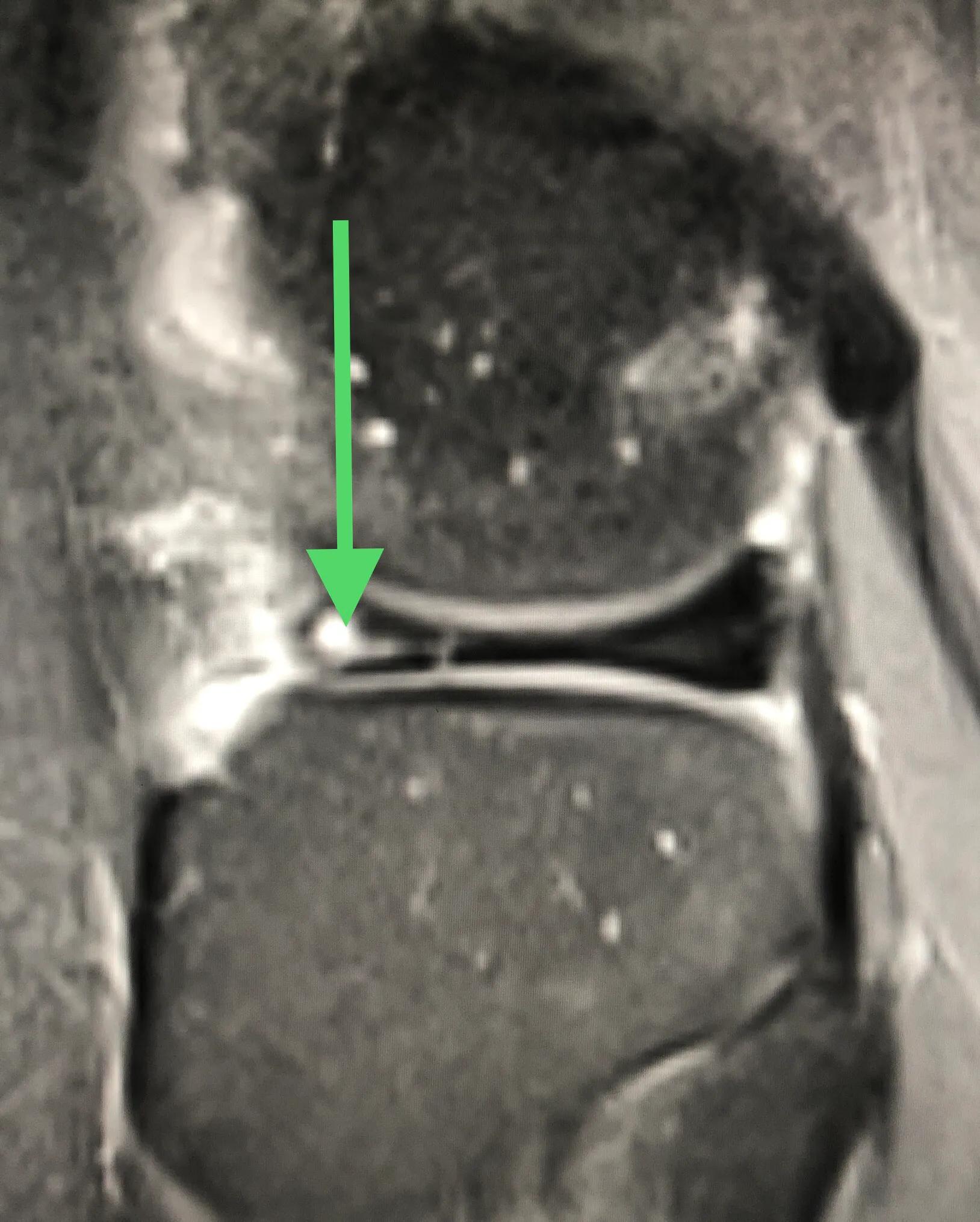 小构件大问题的膝关节半月板