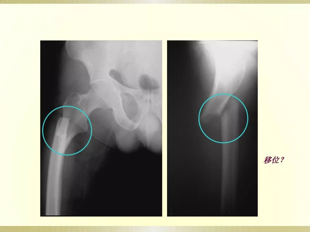 骨科x光片读片技巧,放射科骨科读片教程