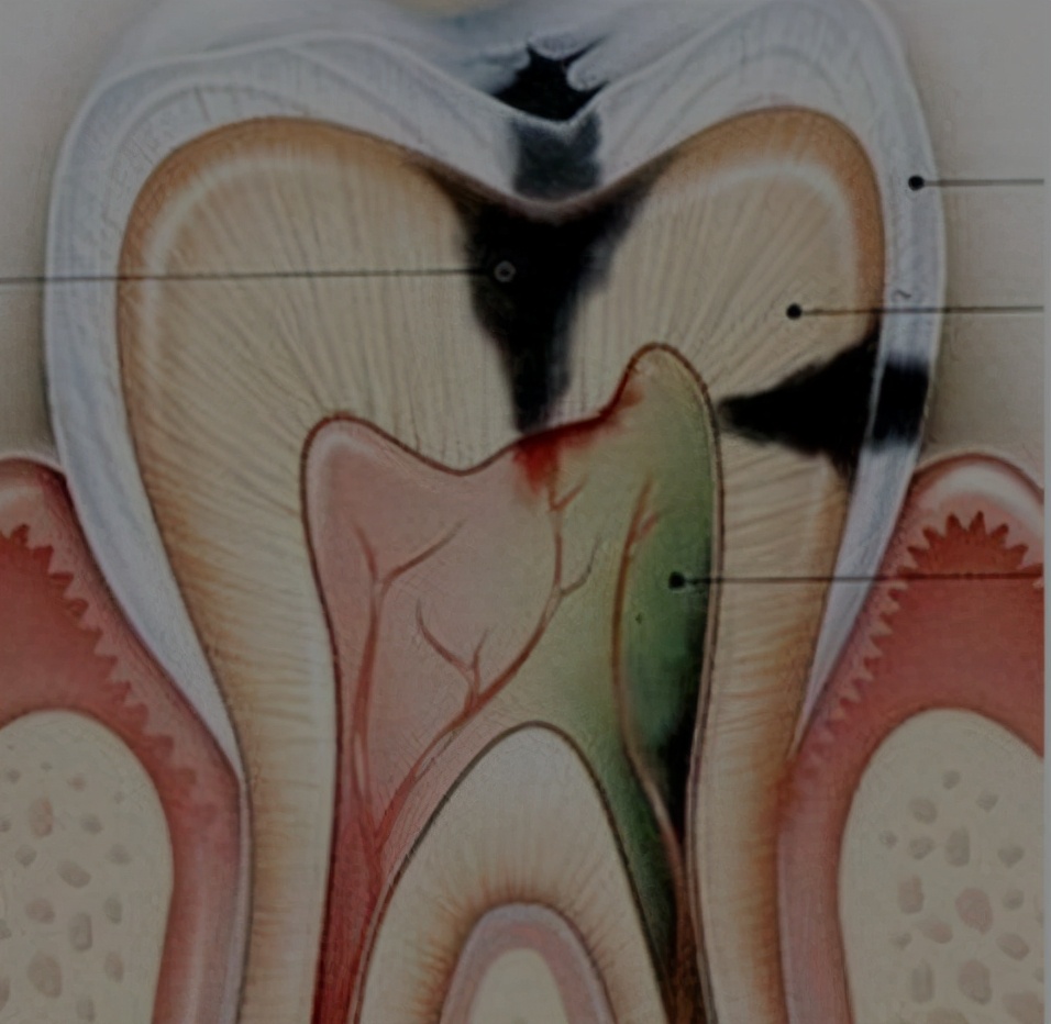 根管治疗封药后为什么反反复复疼痛?