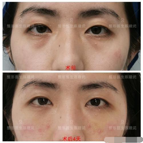 29分钟快速祛眼袋,女士微创去眼袋