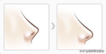 鼻翼缩小外切好吗,鼻翼缩小外切还是内切效果好