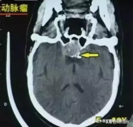 钙化灶是良性肿瘤的可能性大吗,颅内肿瘤钙化发生率最高