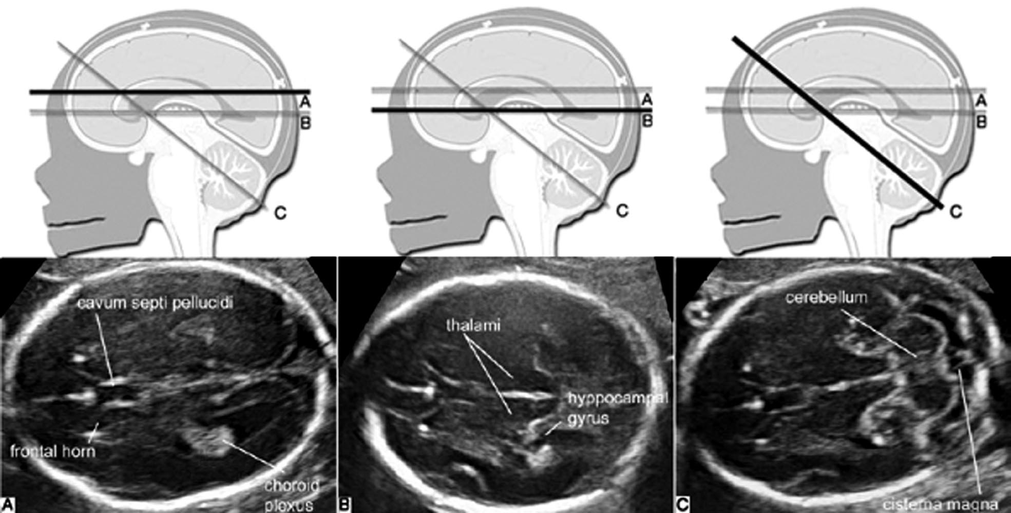 孕期头部彩超查什么,孕期检查胎儿头部有一个地方宽