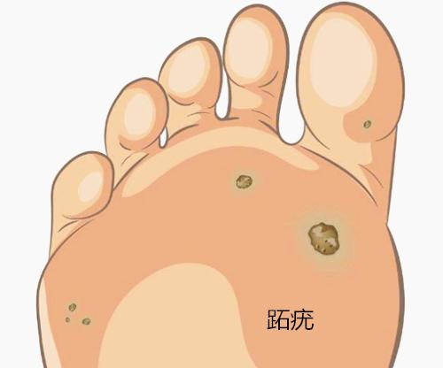 切记不要把跖疣当作鸡眼处理,跖疣和鸡眼到底怎么区分