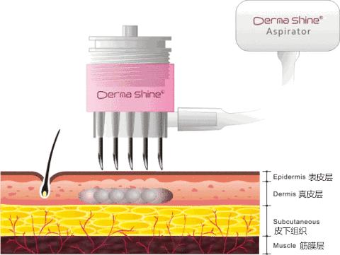 脸上有闭口毛孔粗大适合什么医美,毛孔粗大有闭口黑头该做什么医美