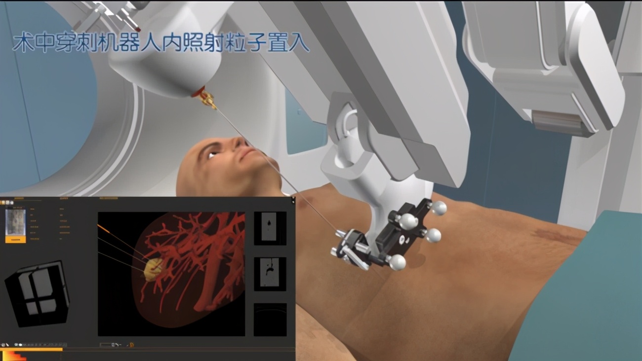 中大医院肿瘤科最新治疗技术,中大肿瘤医院介入科