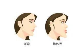 幼儿地包天矫正最佳时间,地包天最佳适合纠正时间