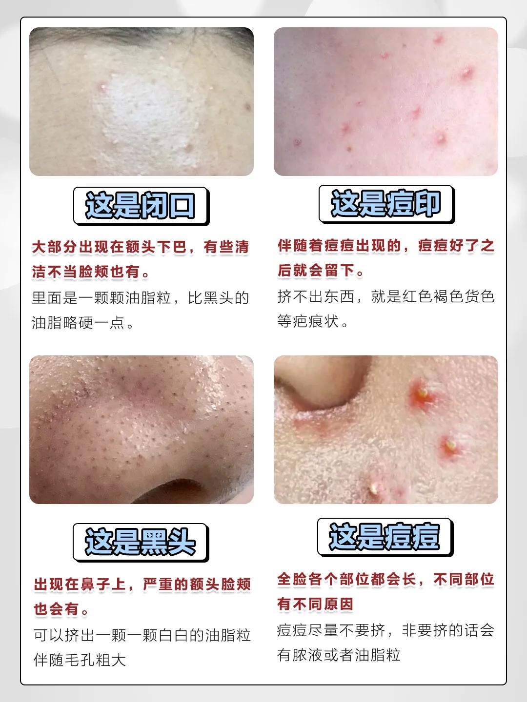 女孩青春期皮肤粗糙如何改善,青春期怎样让皮肤变得细腻