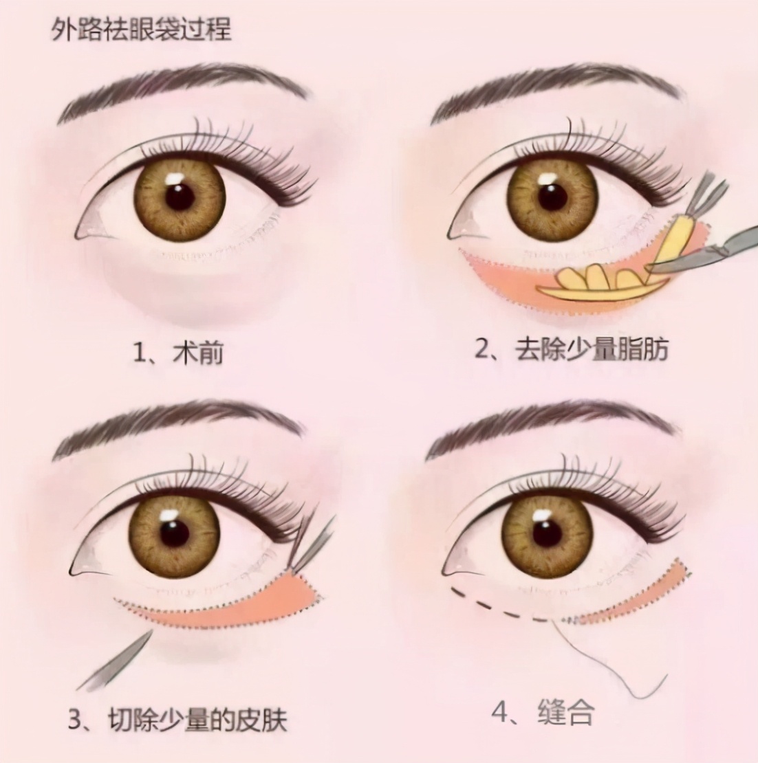 黑眼圈眼袋的最有效的解决方法,眼袋和黑眼圈长一起如何遮住