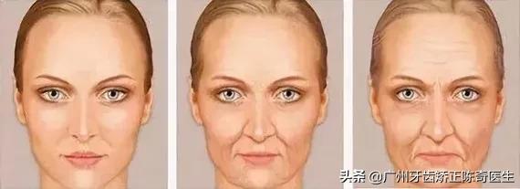 戴牙套会有下颌线,戴牙套的时候人会变丑吗