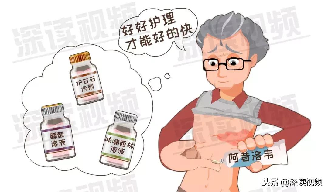 水痘和带状疱疹潜伏期是多久,得了水痘是不是容易得带状疱疹