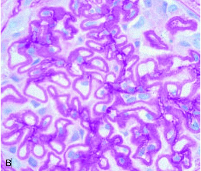 系统性红斑狼疮肾炎症状有哪些呢,系统性红斑狼疮肾炎症状是什么