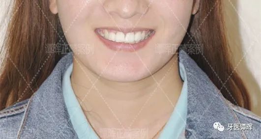 门牙前突牙齿不齐矫正案例分享,门牙和旁边牙齿不齐最快矫正方法