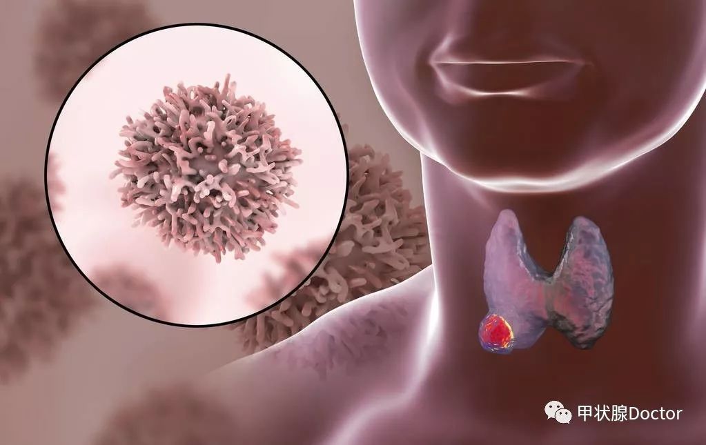甲状腺癌淋巴结转移最严重的后果,甲状腺癌有淋巴结转移能活多久