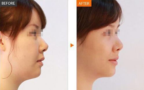 下巴不翘可能不具备这4个标准用这种方法一步解决！