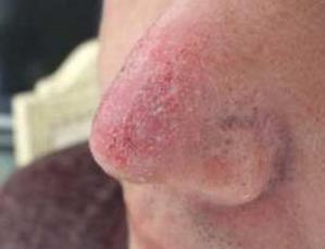 如何应对酒糟鼻,得了酒糟鼻怎么处理好得快