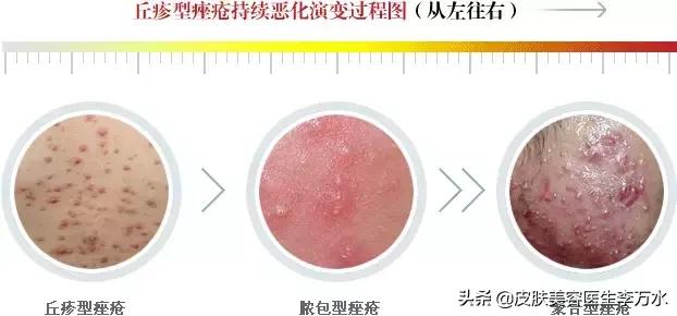 痘痘十大真相,痘痘大全图解
